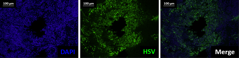 HSV-indizierte Plaquebildung im Tumorgewebeschnitt von Mäusen nach der intratumoralen Virustherapie. DAPI (blau) stellt den Zellkern dar und HSV (grün) die Virusproteine in infizierten Lungenkrebszellen