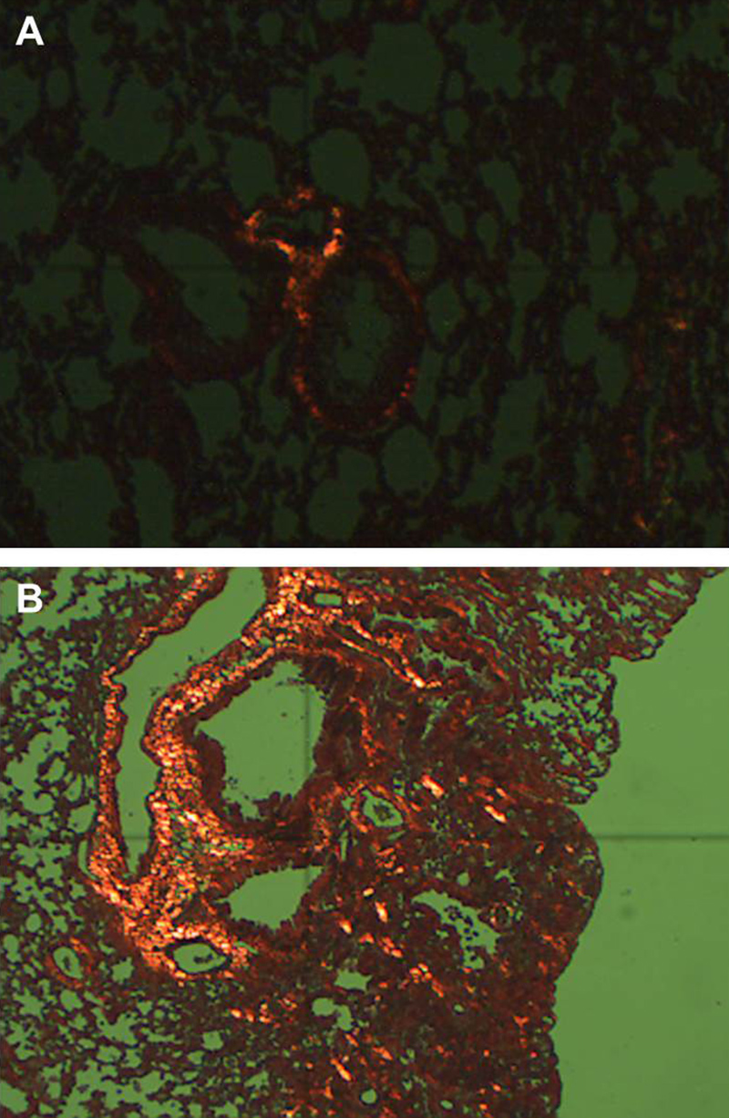 Fibrotic changes in lung tissue of C3H mice. A: Healthy lung tissue (picrosirius red stain) in polarized light. B: Fibrotic lung tissue of a mouse treated with bleomycin (picrosirius red stain) in polarized light.