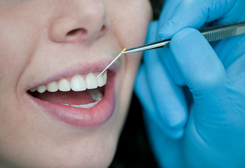 Taking samples for the rapid analysis of periodontalpathogenic agents using the parodontitis chip