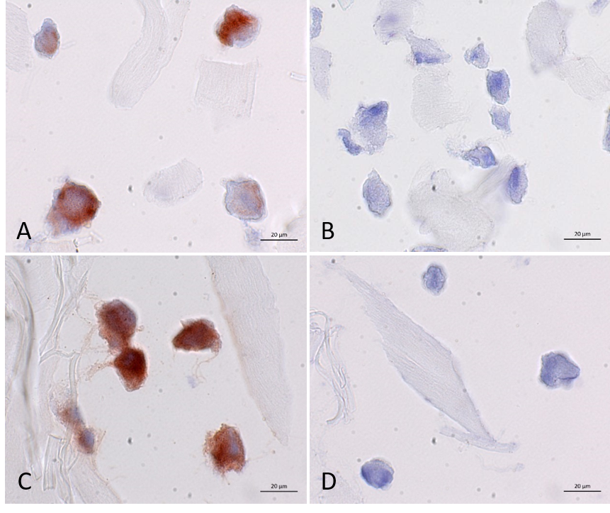 Method validation of immunohistochemical HLA-ABC staining on human umbilical cord mesenchymal stem cells (hUC-MSCs). Specific and sensitive reddish-brown staining of unexpanded (A) and expanded (C) hUC-MSCs with the monoclonal antibody against human MHC class I-antigens (clone W6/32, Agilent company) and a hematoxylin nuclear counterstain. For the negative control, the isotype control antibody (clone DAK-G05, DAKO) was used (B and D) was used (B and D). The unstained collagen fibers of the Chondro-Gide® matrix are visible between the hUC-MSCs (A-D). Method validation of immunohistochemical HLA-ABC staining on human umbilical cord mesenchymal stem cells (hUC-MSCs). Specific and sensitive reddish-brown staining of unexpanded (A) and expanded (C) hUC-MSCs with the monoclonal antibody against human MHC class I-antigens (clone W6/32, Agilent company) and a hematoxylin nuclear counterstain. For the negative control, the isotype control antibody (clone DAK-G05, DAKO) was used (B and D) was used (B and D). The unstained collagen fibers of the Chondro-Gide® matrix are visible between the hUC-MSCs (A-D).